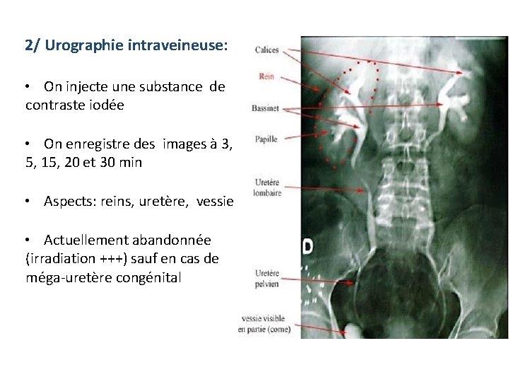 2/ Urographie intraveineuse: • On injecte une substance de contraste iodée • On enregistre