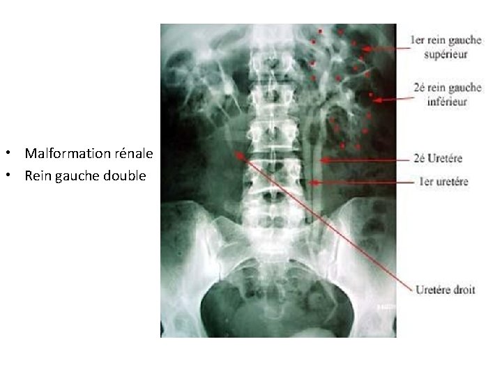  • Malformation rénale • Rein gauche double 