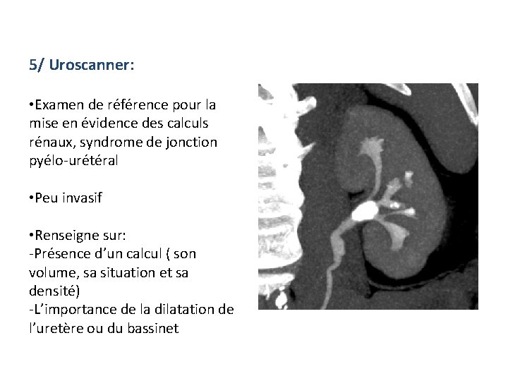 5/ Uroscanner: • Examen de référence pour la mise en évidence des calculs rénaux,