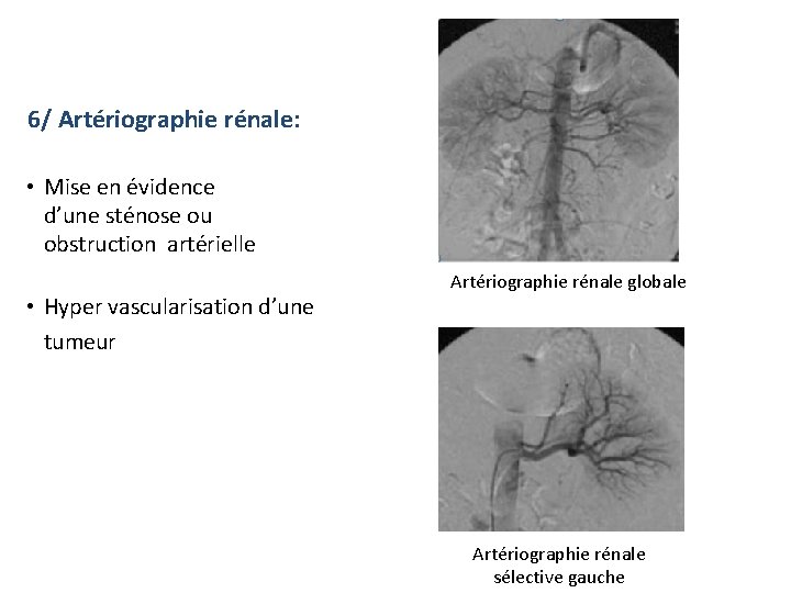 6/ Artériographie rénale: • Mise en évidence d’une sténose ou obstruction artérielle • Hyper