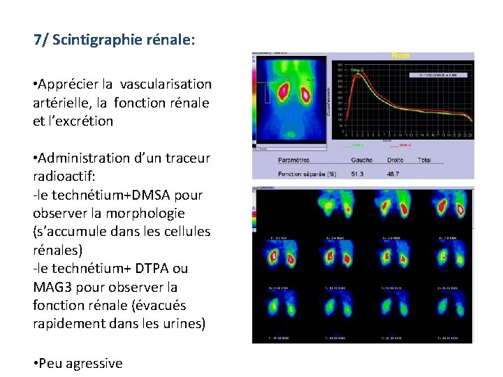 7/ Scintigraphie rénale: • Apprécier la vascularisation artérielle, la fonction rénale et l’excrétion •