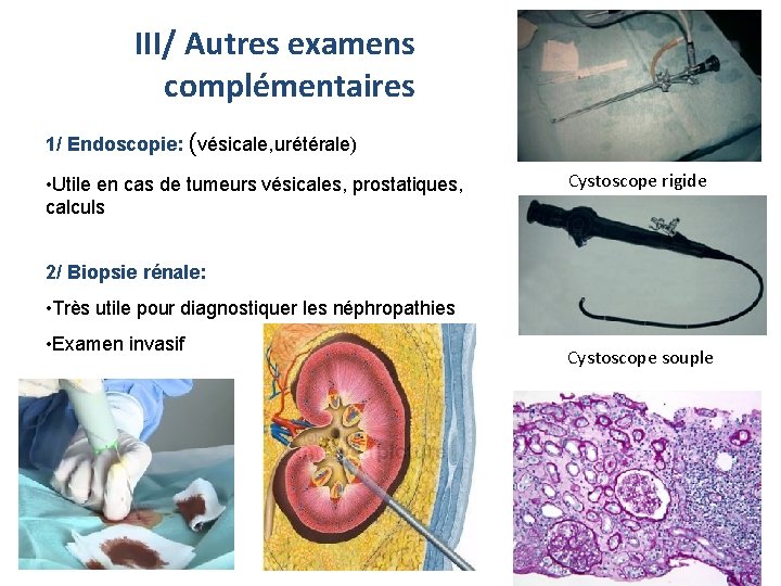 III/ Autres examens complémentaires 1/ Endoscopie: (vésicale, urétérale) • Utile en cas de tumeurs