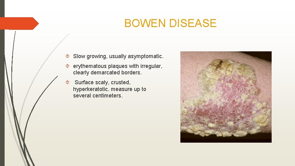 BOWEN DISEASE Slow growing, usually asymptomatic. erythematous plaques with irregular, clearly demarcated borders. Surface