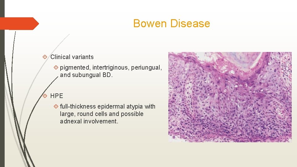 Bowen Disease Clinical variants pigmented, intertriginous, periungual, and subungual BD. HPE full-thickness epidermal atypia