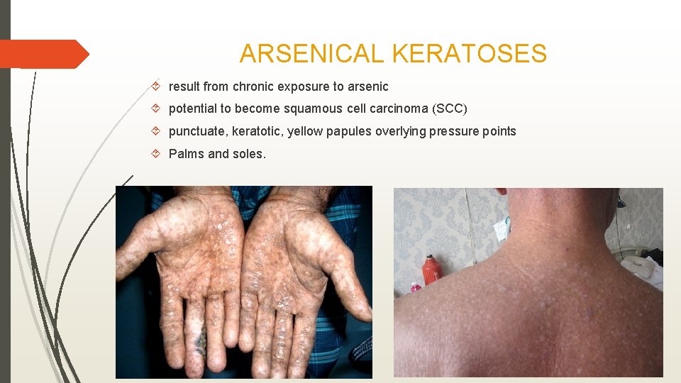 ARSENICAL KERATOSES result from chronic exposure to arsenic potential to become squamous cell carcinoma