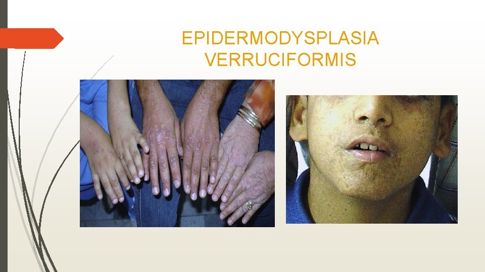 EPIDERMODYSPLASIA VERRUCIFORMIS 