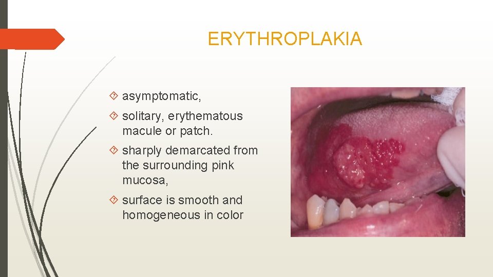 ERYTHROPLAKIA asymptomatic, solitary, erythematous macule or patch. sharply demarcated from the surrounding pink mucosa,