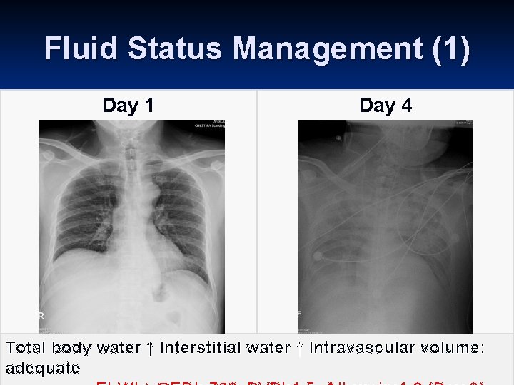 Fluid Status Management (1) Day 1 Day 4 Total body water ↑ Interstitial water