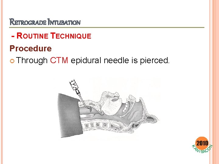 RETROGRADE INTUBATION - ROUTINE TECHNIQUE Procedure Through CTM epidural needle is pierced. 