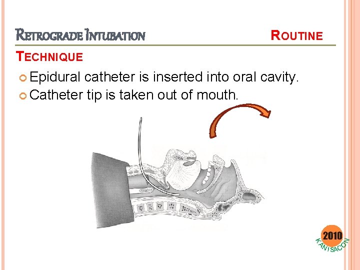 RETROGRADE INTUBATION ROUTINE TECHNIQUE Epidural catheter is inserted into oral cavity. Catheter tip is