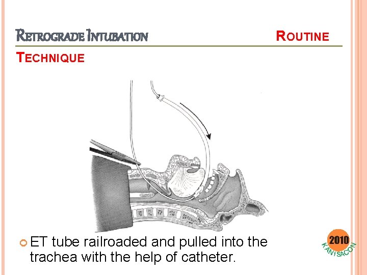 RETROGRADE INTUBATION TECHNIQUE ET tube railroaded and pulled into the trachea with the help