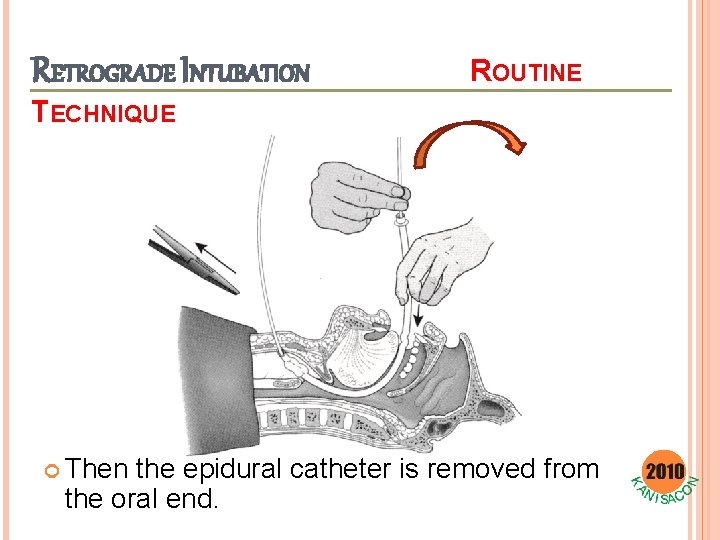 RETROGRADE INTUBATION ROUTINE TECHNIQUE Then the epidural catheter is removed from the oral end.