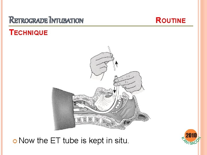 RETROGRADE INTUBATION TECHNIQUE Now the ET tube is kept in situ. ROUTINE 