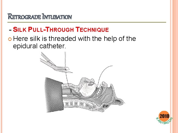 RETROGRADE INTUBATION - SILK PULL-THROUGH TECHNIQUE Here silk is threaded with the help of