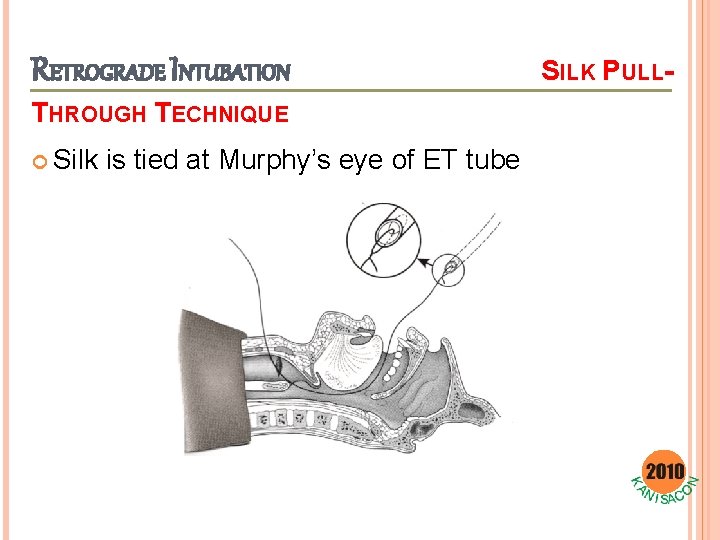 RETROGRADE INTUBATION THROUGH TECHNIQUE Silk is tied at Murphy’s eye of ET tube SILK