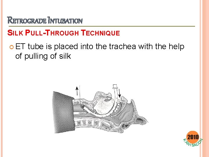 RETROGRADE INTUBATION SILK PULL-THROUGH TECHNIQUE ET tube is placed into the trachea with the