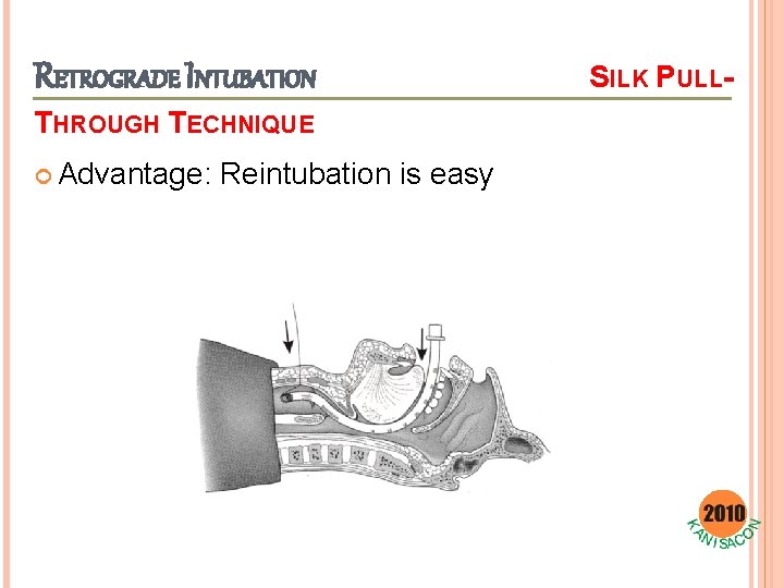 RETROGRADE INTUBATION THROUGH TECHNIQUE Advantage: Reintubation is easy SILK PULL- 