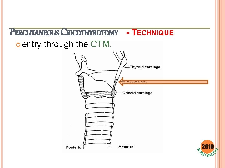 PERCUTANEOUS CRICOTHYROTOMY entry through the CTM. - TECHNIQUE 