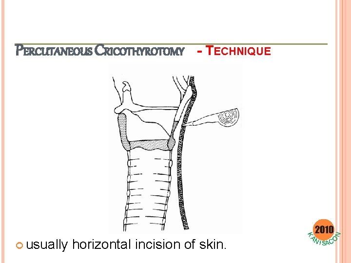 PERCUTANEOUS CRICOTHYROTOMY usually - TECHNIQUE horizontal incision of skin. 