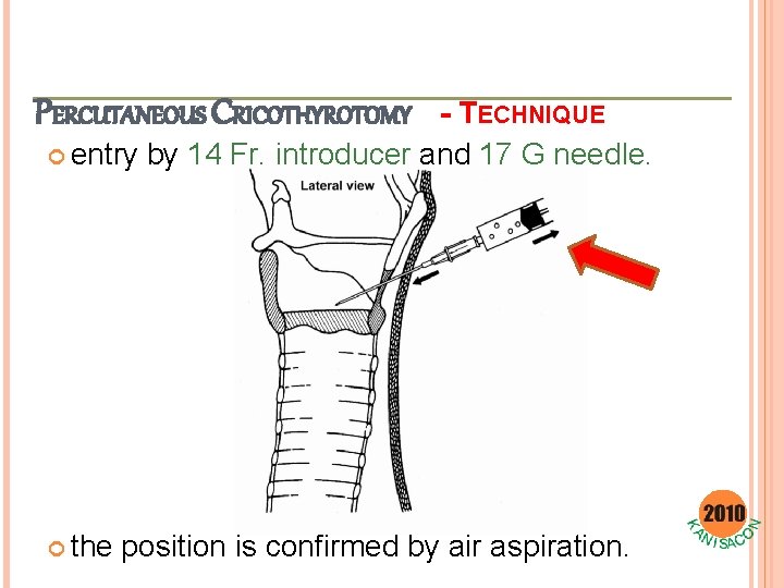 PERCUTANEOUS CRICOTHYROTOMY - TECHNIQUE entry by 14 Fr. introducer and 17 G needle. the