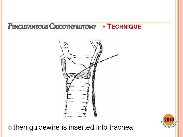 PERCUTANEOUS CRICOTHYROTOMY then - TECHNIQUE guidewire is inserted into trachea. 