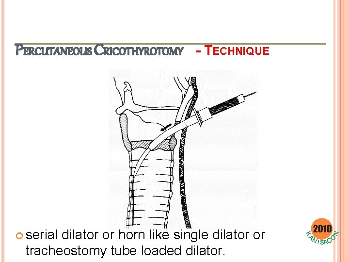 PERCUTANEOUS CRICOTHYROTOMY serial - TECHNIQUE dilator or horn like single dilator or tracheostomy tube