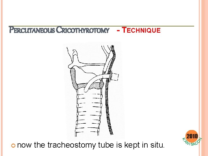 PERCUTANEOUS CRICOTHYROTOMY now - TECHNIQUE the tracheostomy tube is kept in situ. 