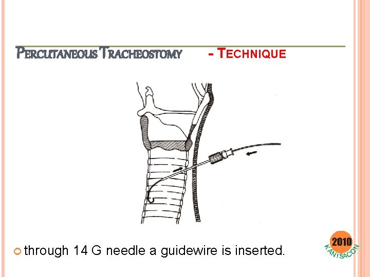PERCUTANEOUS TRACHEOSTOMY through - TECHNIQUE 14 G needle a guidewire is inserted. 