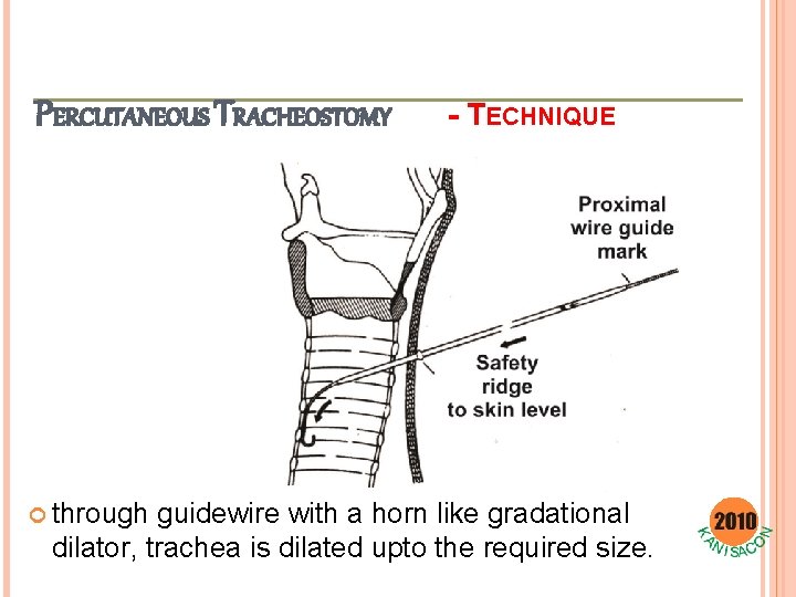 PERCUTANEOUS TRACHEOSTOMY through - TECHNIQUE guidewire with a horn like gradational dilator, trachea is