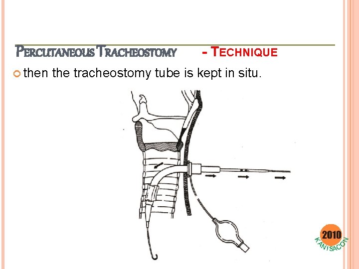 PERCUTANEOUS TRACHEOSTOMY then - TECHNIQUE the tracheostomy tube is kept in situ. 