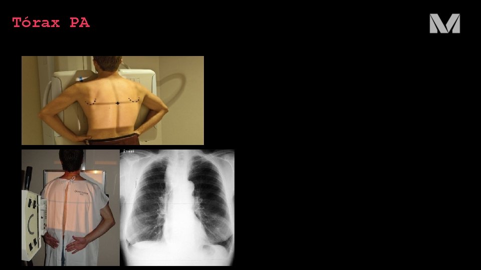 Tórax PA 