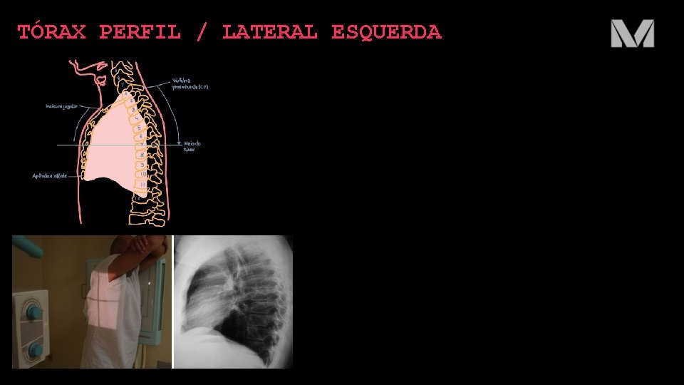 TÓRAX PERFIL / LATERAL ESQUERDA 