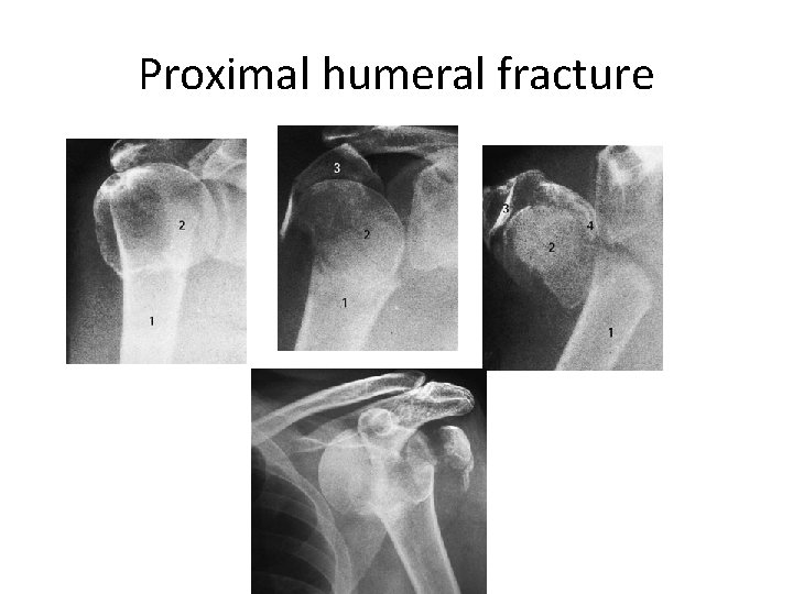 Proximal humeral fracture 