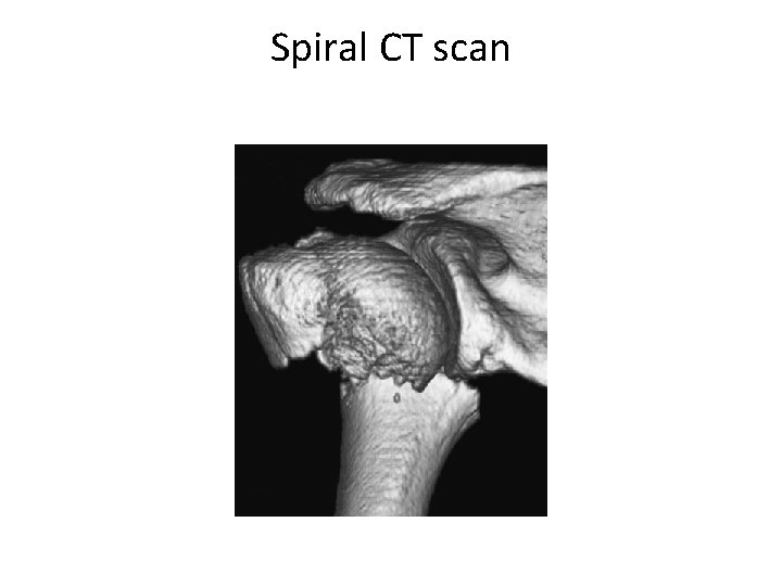 Spiral CT scan 