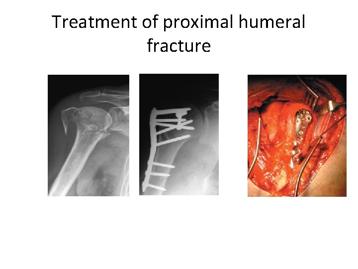 Treatment of proximal humeral fracture 