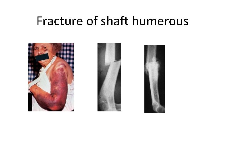 Fracture of shaft humerous 