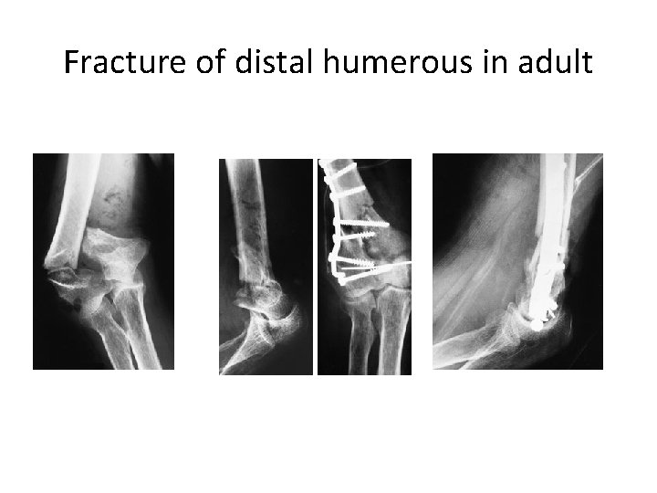 Fracture of distal humerous in adult 