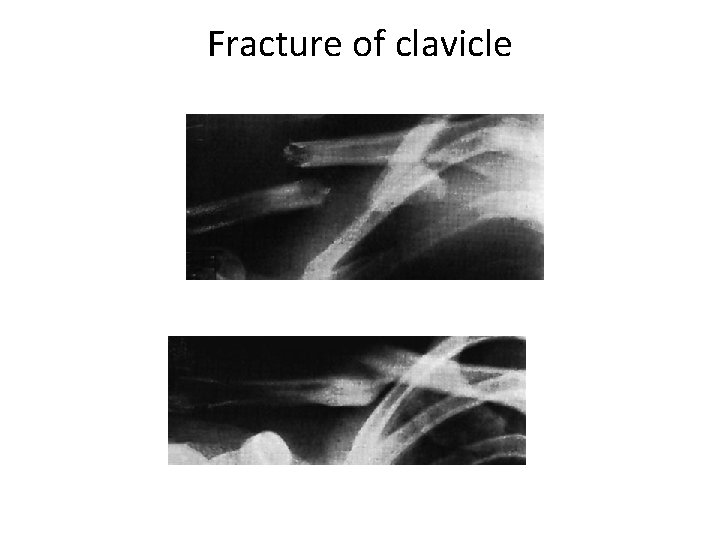 Fracture of clavicle 