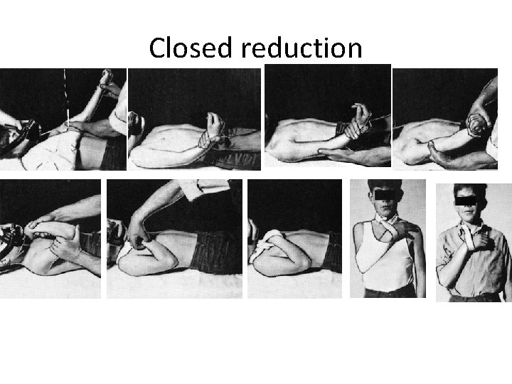 Closed reduction 
