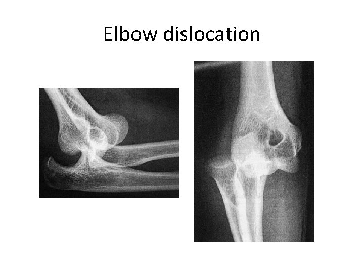 Elbow dislocation 