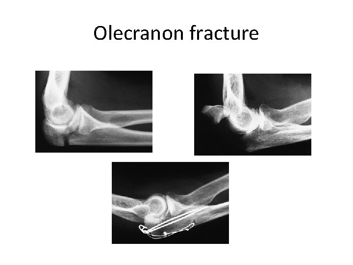 Olecranon fracture 