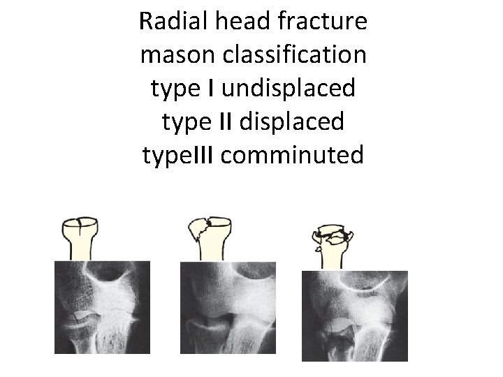 Radial head fracture mason classification type I undisplaced type II displaced type. III comminuted