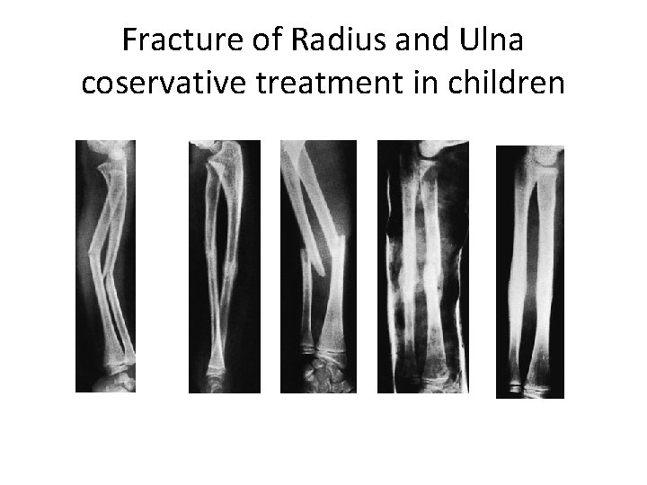 Fracture of Radius and Ulna coservative treatment in children 