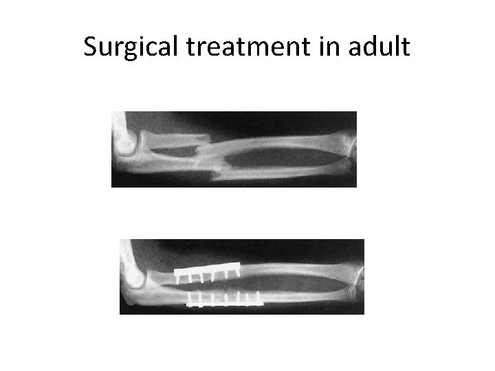 Surgical treatment in adult 