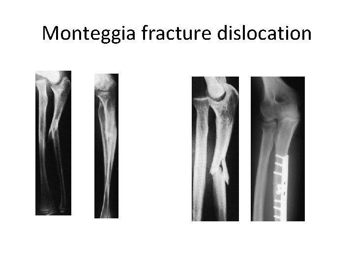 Monteggia fracture dislocation 