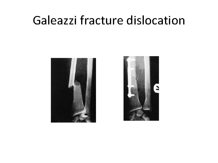 Galeazzi fracture dislocation 
