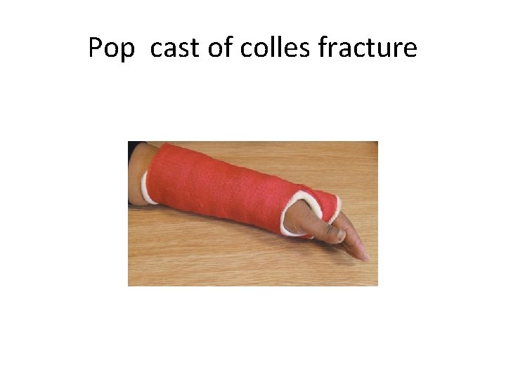 Pop cast of colles fracture 