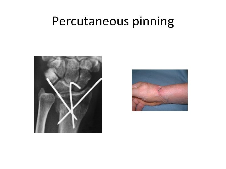 Percutaneous pinning 