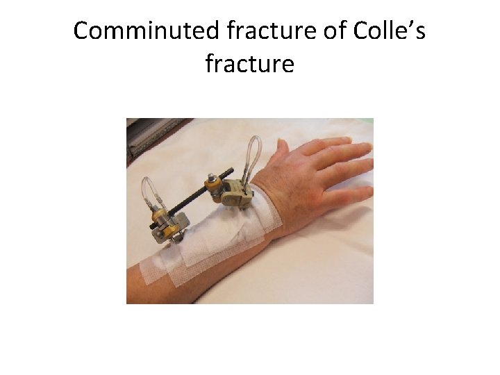 Comminuted fracture of Colle’s fracture 