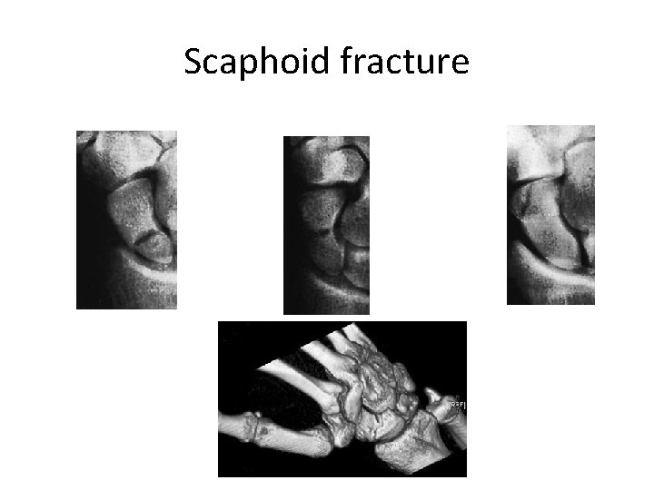 Scaphoid fracture 